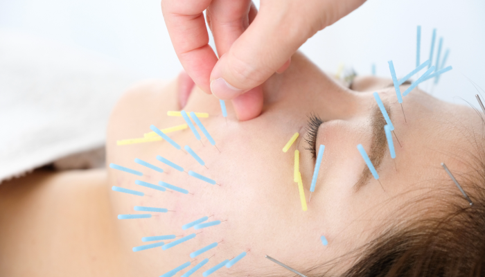 広島市楽々園駅すぐ 美容鍼 小顔整体専門センター 伊関鍼灸整骨センター美容鍼 小顔矯正by 株 創生